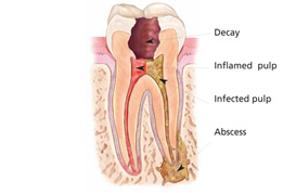 Diseased Tooth