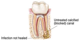 Root Canal Retreatment