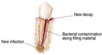 Root Canal Retreatment