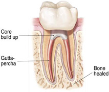 Root Canal Completed